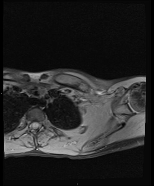 File:Chronic reactive multifocal osteomyelitis (CRMO) - clavicle (Radiopaedia 56406-63114 Axial T1 fat sat 12).jpg