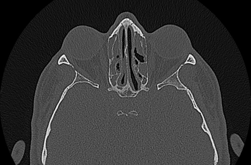 File:Chronic rhinosinusitis (Radiopaedia 65079-74075 Axial bone window 55).jpg