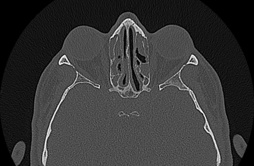 Chronic rhinosinusitis (Radiopaedia 65079-74075 Axial bone window 55).jpg