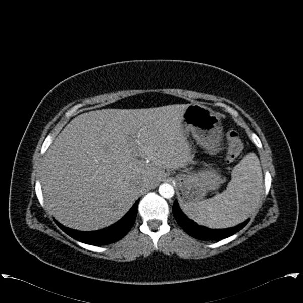 File:Chronic thromboembolic pulmonary hypertension (CTEPH) (Radiopaedia 74597-85531 Axial C+ CTPA 50).jpg
