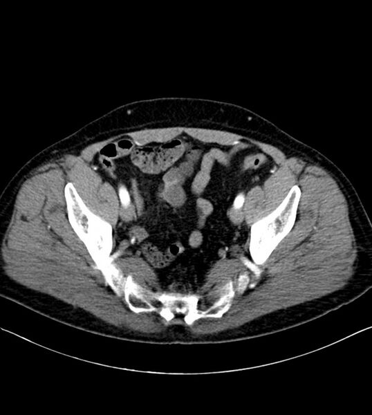 File:Clear cell renal cell carcinoma (Radiopaedia 85006-100539 B 75).jpg