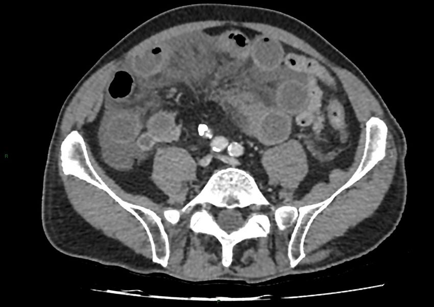 Closed loop small bowel obstruction with ischemia (Radiopaedia 84180-99456 A 80).jpg