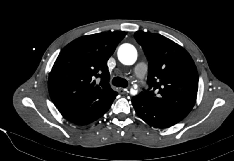 File:Coarctation of aorta with aortic valve stenosis (Radiopaedia 70463-80574 A 57).jpg