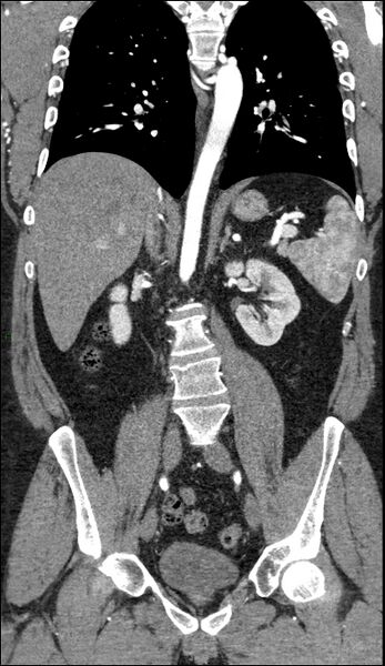 File:Coarctation of the aorta (Radiopaedia 74632-88521 B 141).jpg
