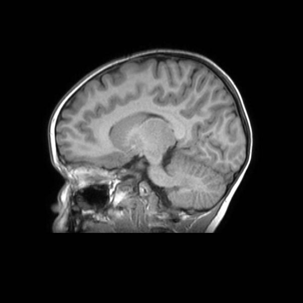 File:Cochlear nerve aplasia - unilateral (Radiopaedia 87910-104413 Sagittal T1 21).jpg