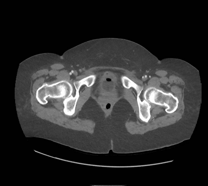 File:Colonic pseudo-obstruction (Radiopaedia 79752-92980 A 187).png