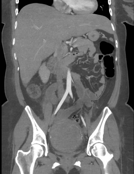 File:Colonic pseudo-obstruction (Radiopaedia 79752-92980 B 34).png