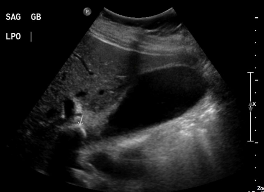 Figure 10.1A Sagittal ultrasound of the Gallbladder.jpg