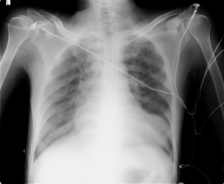 File:Left ventricular aneurysm (Radiopaedia 13836).jpg