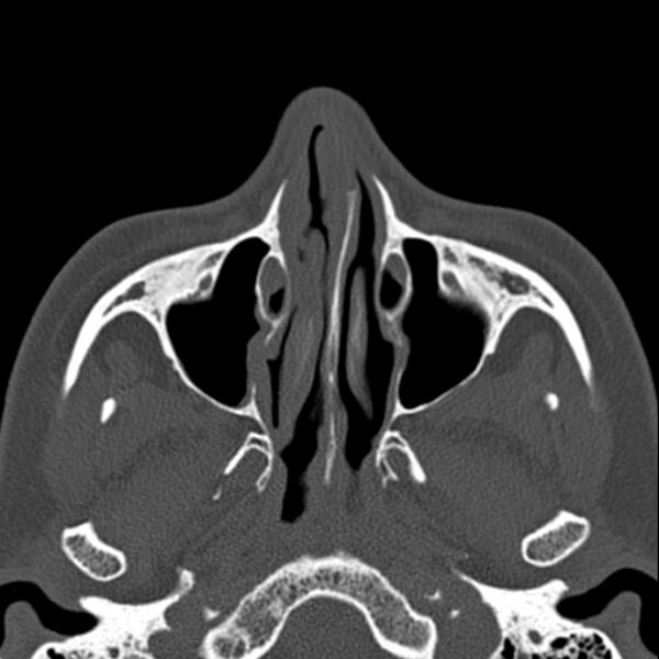 File:Nasal septal perforation (Radiopaedia 25030-25289 Axial bone window 20).jpg