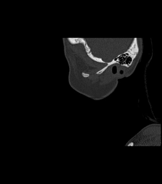 File:Nasoorbitoethmoid fracture (Radiopaedia 90044-107205 Sagittal bone window 129).jpg