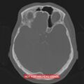 Nasopharyngeal carcinoma recurrence - skull base destruction (Radiopaedia 29107-29490 Axial bone window 67).jpg