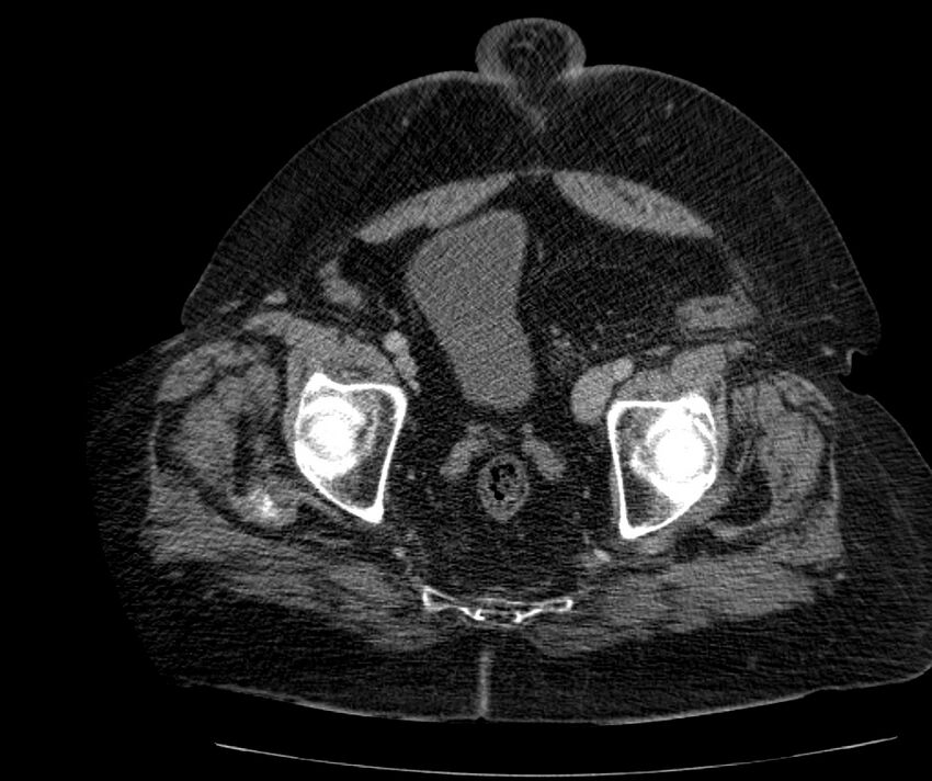 Nephroptosis with inguinal hernia containing perirenal fat (Radiopaedia 56632-63391 C 302).jpg