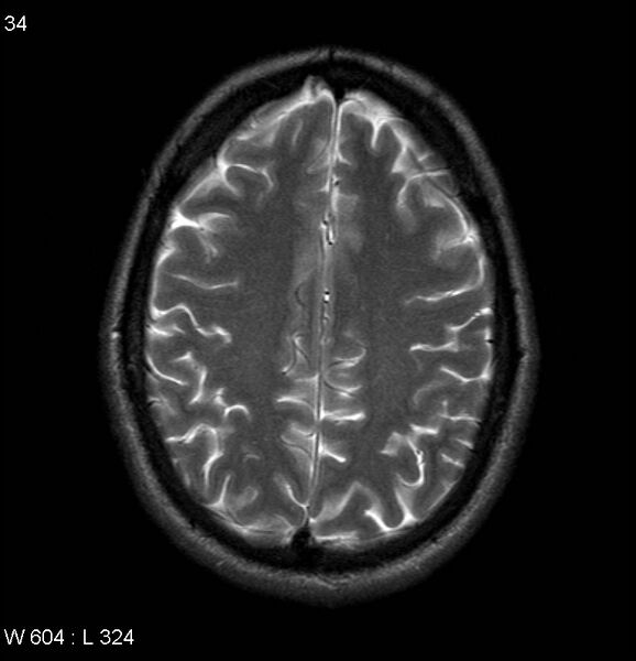 File:Neurosarcoidosis (Radiopaedia 10930-17204 Axial T2 15).jpg