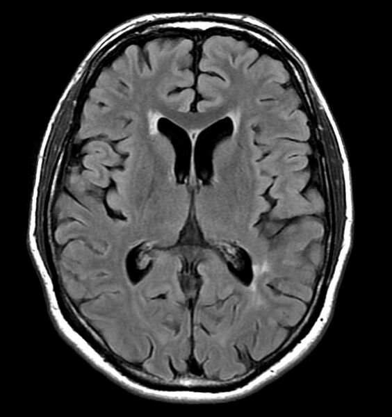 File:Neurosarcoidosis (Radiopaedia 11674-12037 Axial 1).jpg