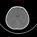 Non-accidental injury - bilateral subdural with acute blood (Radiopaedia 10236-10765 Axial non-contrast 14).jpg