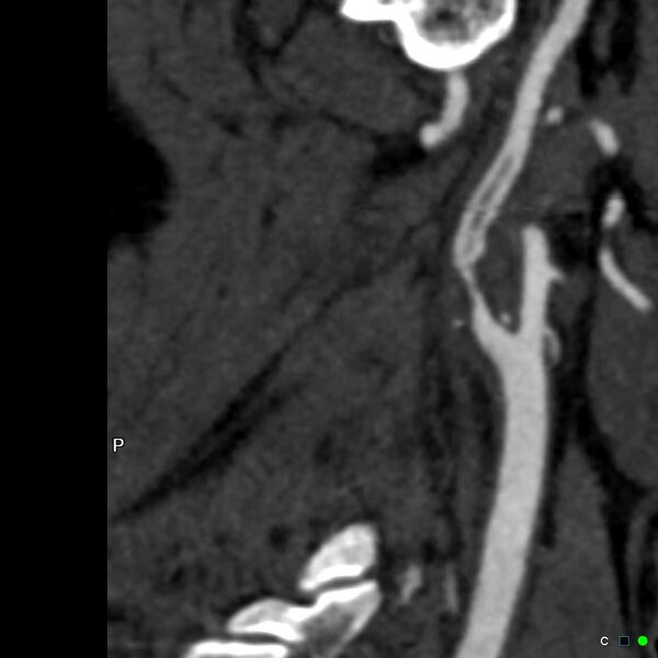 File:Non-occlusive intraluminal internal carotid artery thrombus (Radiopaedia 37751-39658 A 20).jpg