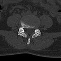 Normal CT lumbar spine (Radiopaedia 53981-60118 Axial bone window 53).jpg