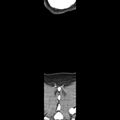 Normal CT of the neck (Radiopaedia 14575-14500 Coronal C+ 56).jpg