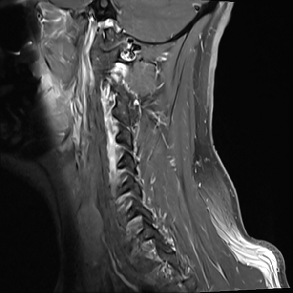 File:Normal MRI cervical spine (infection protocol) (Radiopaedia 53916-60039 I 1).png