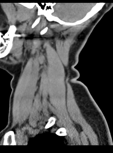 File:Normal cervical spine MRI (including Dixon) (Radiopaedia 42762-45926 C 8).png