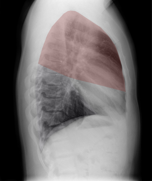 File:Normal chest x-ray - lobes (illustration) (Radiopaedia 58938-66192 H 1).png
