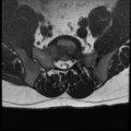 Normal lumbar spine MRI (Radiopaedia 35543-37039 Axial T2 5).png
