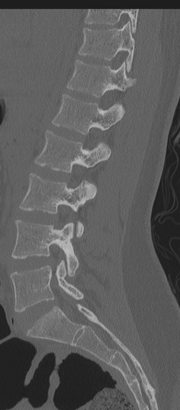 File:Normal lumbosacral CT (Radiopaedia 37923-39867 Sagittal bone window 58).png