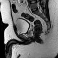 Normal prostate (MRI) (Radiopaedia 29986-30535 Sagittal T2 9).jpg
