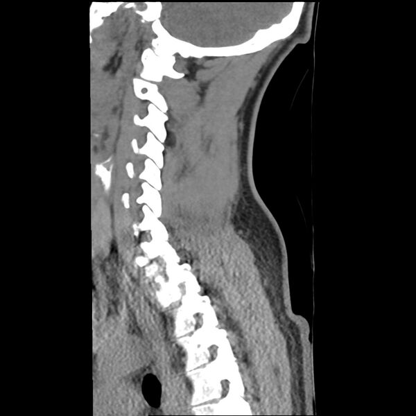 File:Normal trauma spine imaging (Radiopaedia 31753-32686 A 30).jpg