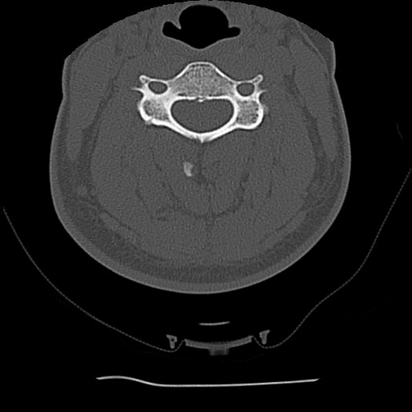 File:Normal trauma spine imaging (Radiopaedia 31753-32686 Axial bone window 38).jpg