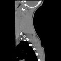 Normal trauma spine imaging (age 16) (Radiopaedia 45335-49358 C 36).jpg