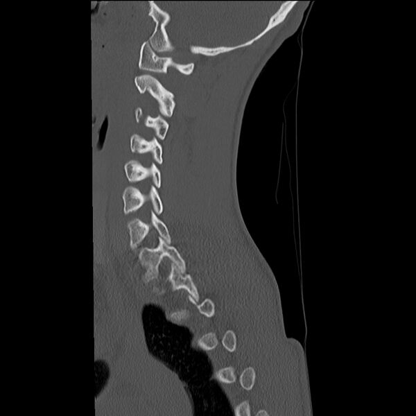 File:Normal trauma spine imaging (age 16) (Radiopaedia 45335-49358 Sagittal bone window 27).jpg