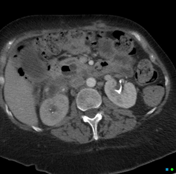 File:Obstructed infected horseshoe kidney (Radiopaedia 18116-17898 B 8).jpg