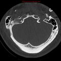 Occipital condyle fracture (Radiopaedia 18366-18208 Axial bone window 8).jpg