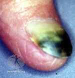 Pseudomonas-candida infection (DermNet NZ hair-nails-sweat-paron-ps).jpg