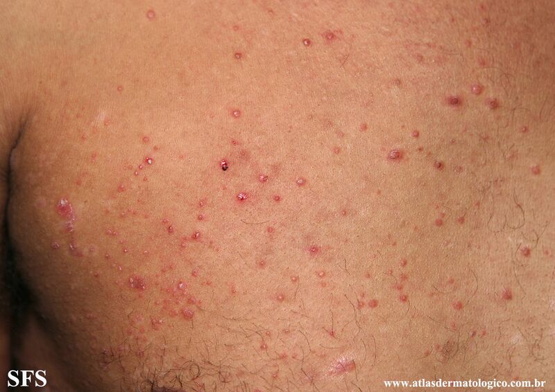 File:Psoriasis (Dermatology Atlas 119).jpg