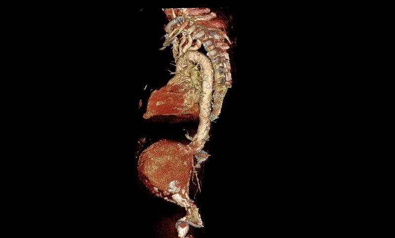 File:Abdominal aortic aneurysm- extremely large, ruptured (Radiopaedia 19882-19921 3D 10).jpg