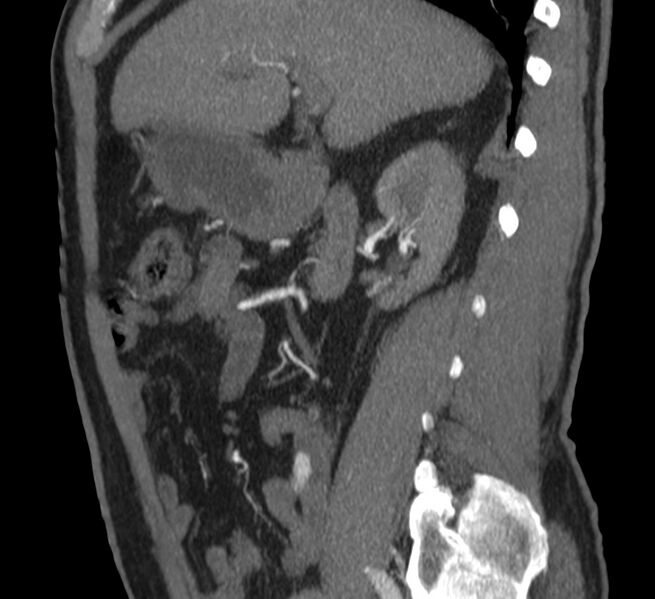 File:Abdominal aortic aneurysm (Radiopaedia 22421-22458 D 10).jpg
