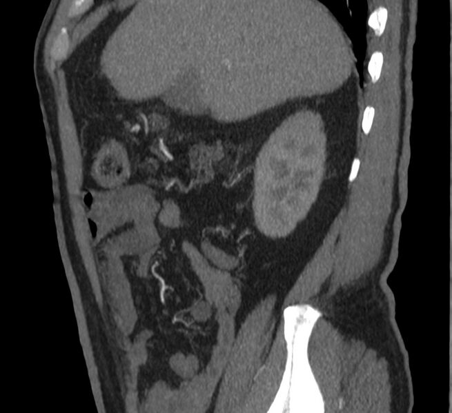 File:Abdominal aortic aneurysm (Radiopaedia 22421-22458 D 4).jpg