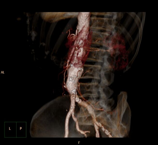 File:Abdominal aortic aneurysm (Radiopaedia 23703-23856 3D 17).jpg