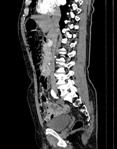 File:Abdominal aortic aneurysm (Radiopaedia 83581-98689 Sagittal C+ arterial phase 29).jpg