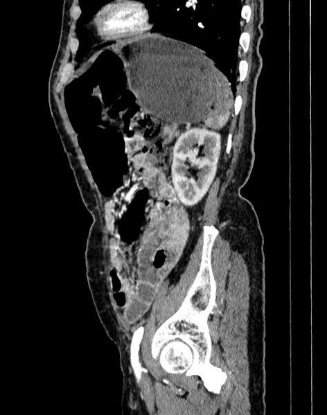 File:Abdominal aortic aneurysm (Radiopaedia 83581-98689 Sagittal C+ arterial phase 96).jpg