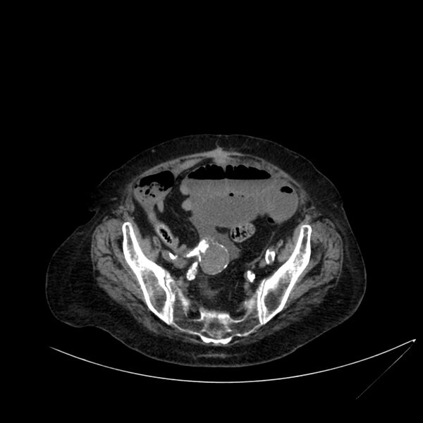 File:Abdominal aortic aneurysm - impending rupture (Radiopaedia 19233-19246 Axial non-contrast 100).jpg