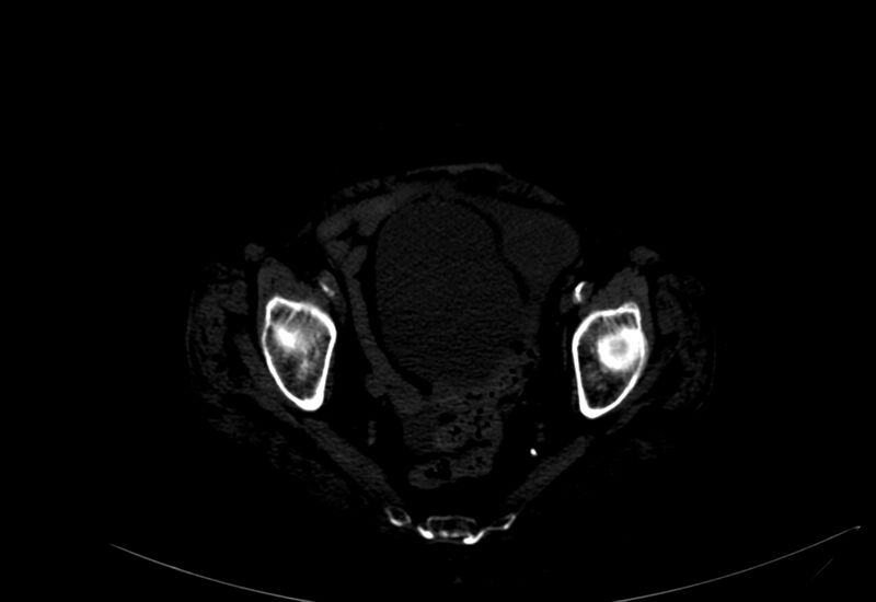 File:Abdominal aortic aneurysm - impending rupture (Radiopaedia 19233-19246 B 59).jpg