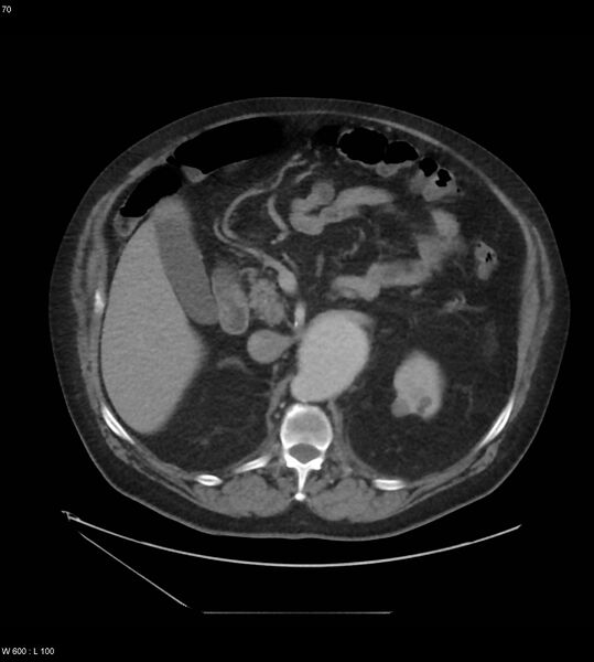 File:Abdominal aortic aneurysm with intramural hematoma then rupture (Radiopaedia 50278-55631 Axial C+ arterial phase 61).jpg