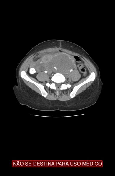File:Abdominal desmoid tumor (Radiopaedia 44024-47540 Axial C+ arterial phase 27).jpg