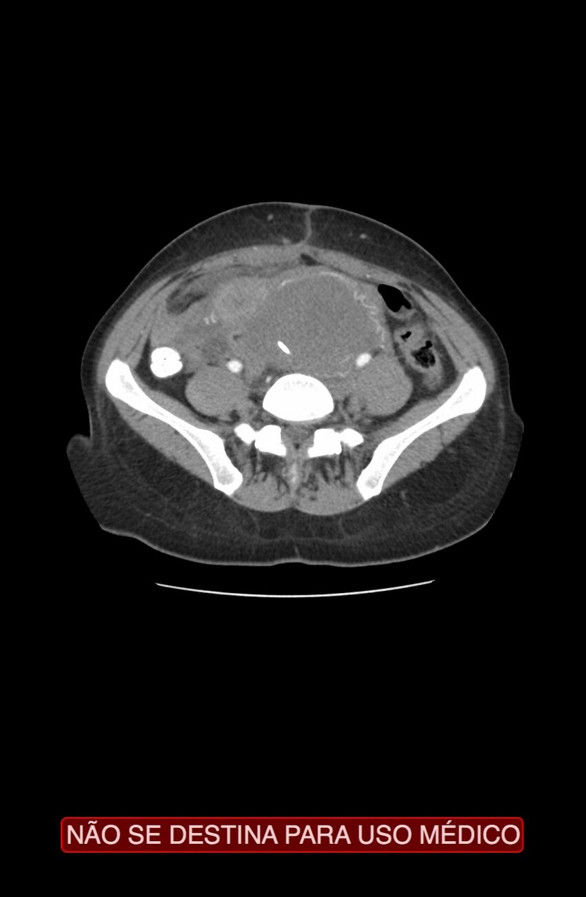 Abdominal desmoid tumor (Radiopaedia 44024-47540 Axial C+ arterial phase 27).jpg