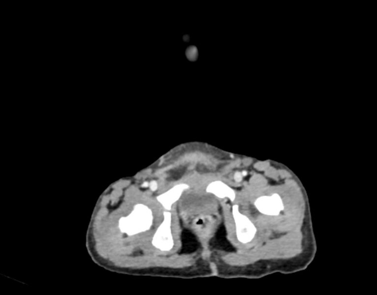 File:Abdominal premesenteric cystic lymphangioma (Radiopaedia 82995-97350 Axial C+ portal venous phase 67).jpg