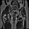 Abdominal wall endometriosis (Radiopaedia 83702-98847 Coronal T2 11).jpg